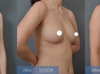 療程效果因人而異，上圖為大B小C罩杯女性在做完自體脂肪隆乳之後​手術後兩個月、手術後十個月成效